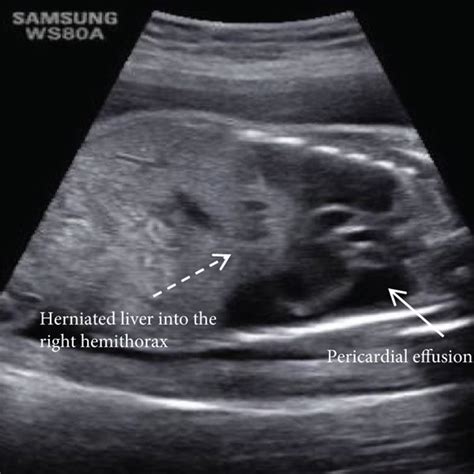 Prenatal Ultrasound Images Of Sagittal And Transverse Sections Of Fetal