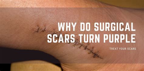 Why Do Surgical Scars Turn Purple Treat Your Scars