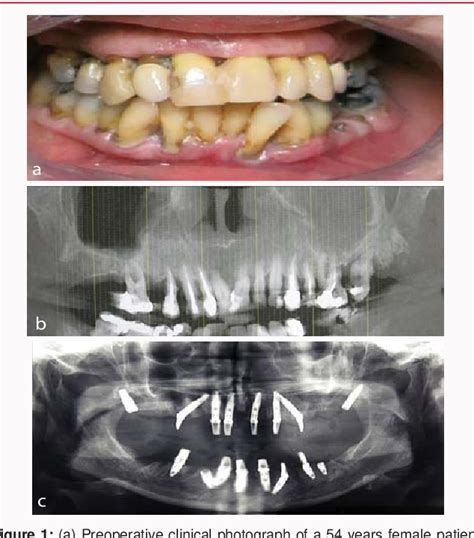 [pdf] Pterygoid Dental Implants An Alternative Solution For Treatment Of Posterior Atrophic