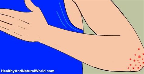 Bumps On Elbows Causes Effective Treatments And When To See A Doctor