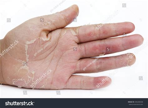 Photo De Stock Dry Hands Peel Contact Dermatitis Fungal 446288338