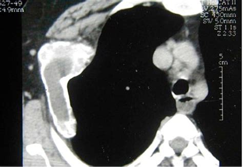 Aneurysmal Bone Cyst Of The Rib A Case Report Journal Of Medical