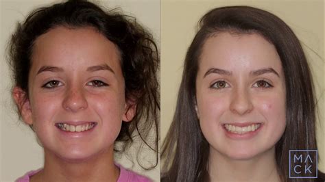 Before And After For Severe Crowding Without Extractions Traditional Braces Youtube