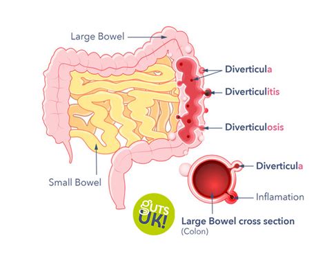 Colitis Versus Diverticulitis Diverticulitis Vs Ulcerative Colitis A