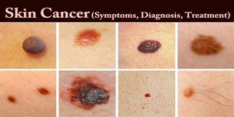 Skin Cancer Symptoms Diagnosis Treatment Zoefact