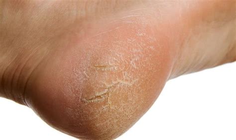 Type 2 Diabetes Symptoms Three Signs To Look Out For On The Skin