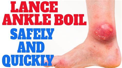 Lancing A Boil Ankle Skin Abscess Why Ankle Boils Are Bad