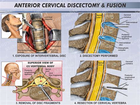 Anterior Cervical Discectomy And Fusion Female Order