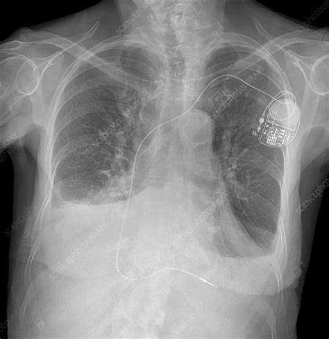 Heart Failure X Ray Stock Image C053 3918 Science Photo Library