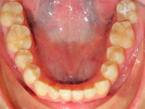 Occlusal Photo Of Mandibular Dentition The Brace Place Orthodontics