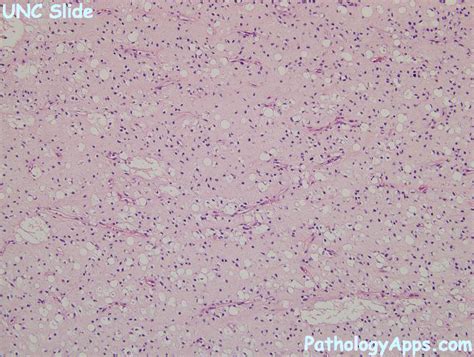 Myxoid Liposarcoma Soft Tissue Histology