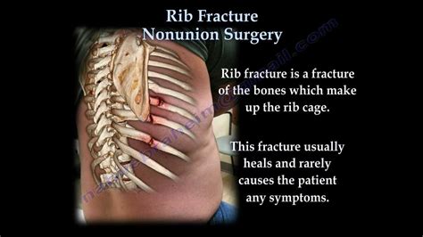 Rib Fracture Nonunion Surgery Everything You Need To Know Dr Nabil Ebraheim Youtube