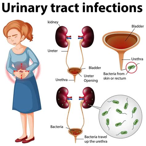 Urinary Tract Infection Uti Symptoms Diagnosis And Treatment