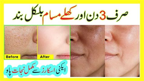 How To Reduce Pores On Face Permanently Get Rid Of Large Pores