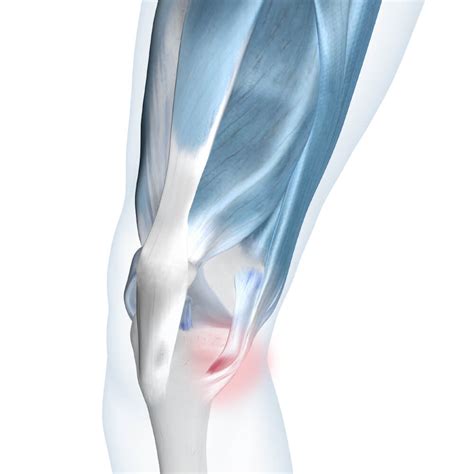 Pes Anserine Bursitis Causes Symptoms Treatment Options Knee Health Bauerfeind