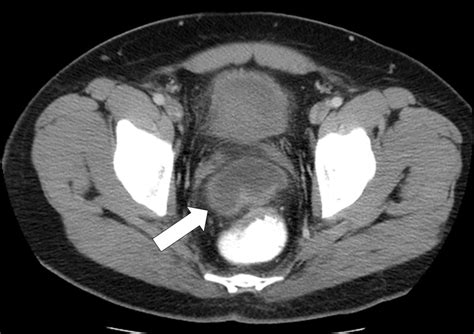 Axial Ct Of The Pelvis Oral Contrast Is Noted In The Rectum A Rim