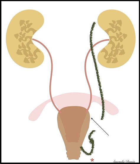 Cureus | Transection of Duplex Ureter During Vaginal ...