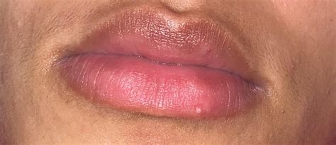 What Is This Bump On My Lip Rdermatology