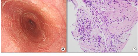 Figure 3 From Eosinophilic Gastrointestinal Disorder Presenting As