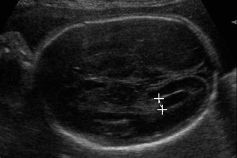 Coronal Measurement Of The Fetal Lateral Ventricles Comparison Between