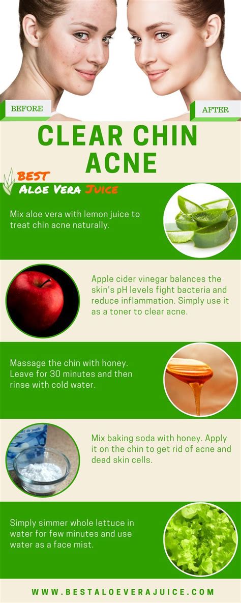 Clear Chin Acne Chin Acne Remedies Chin Acne How To Get Rid Of