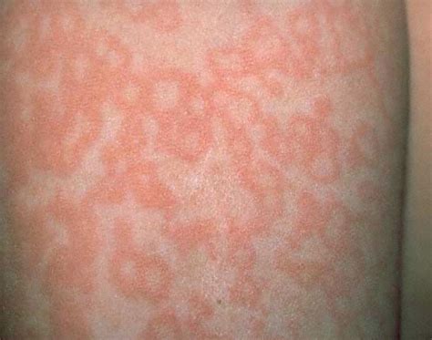 Fifth Disease Rash Pictures Pictures Photos