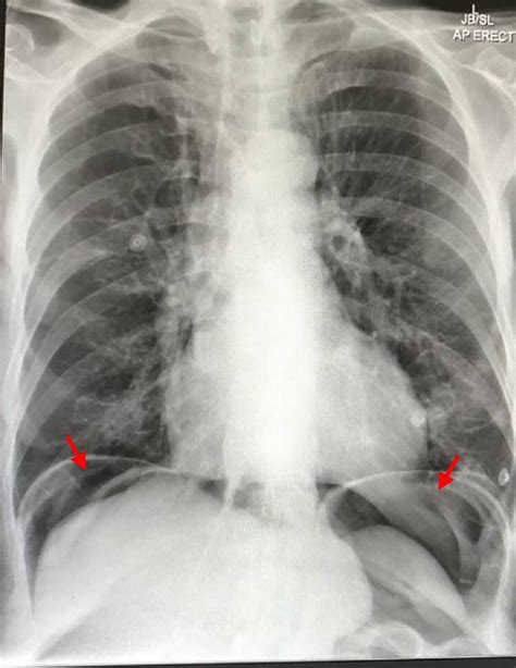 Chest X Ray Showing Air Under The Diaphragm Suggestive Of Download
