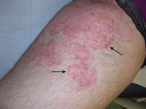 Atypical Psoriasis The Bmj