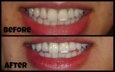 To maintain white teeth, you will need to be adamant about your daily oral hygiene habits and focused on eliminating existing stains. Does Activated Charcoal Whiten Teeth Reddit - TeethWalls