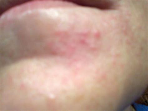 Small Blister Type Rash From Corners Of Mouth Down To Chin Chin Acne