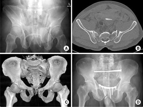 Anatomy Classification And Radiology Of The Pelvic Fracture