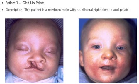 Pediatric Cleft Lip And Palate