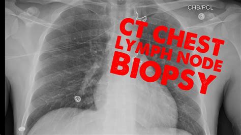Ct Chest Lymph Node Biopsy Youtube
