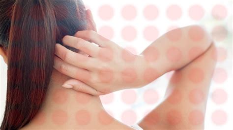 36 Eczema Rash On Back Of Neck