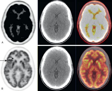 Brain On Fdg Petct Radiology Key