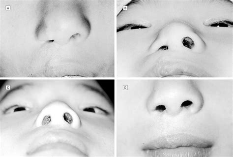 Secondary Rhinoplasty In Nasal Deformity Associated With The Unilateral
