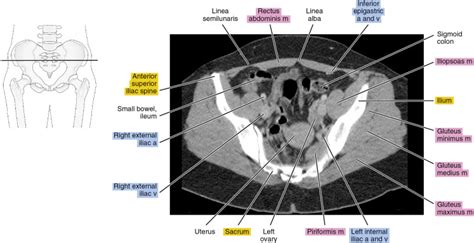 Ct Scan Tips Protocols Ct Anatomy Of The Female Pelvis Sexiz Pix