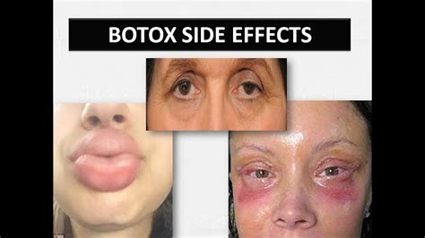 Botox Injection Side Effects Youtube