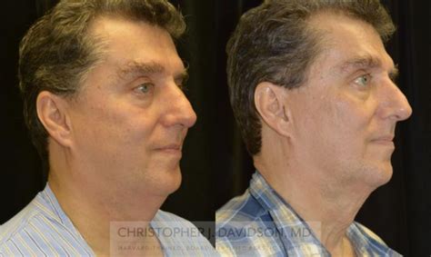 Kybella® For Double Chins Before And After Pictures Case 140 Boston