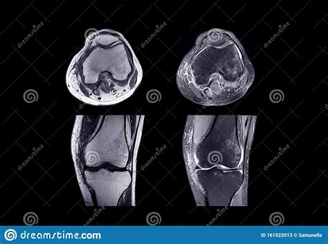 Mri Knee Joint Or Magnetic Resonance Imaging Stock Image Image Of