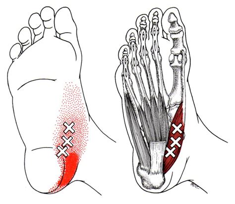 Foot Pain Intrinsic Muscles Trigger Points Try West Suburban Pain Relief