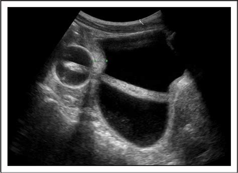 Figure 1 From Intraperitoneal Bladder Perforation After Routine