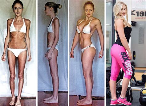 15 wstrząsających zdjęć ludzi którzy wygrali walkę z anoreksją