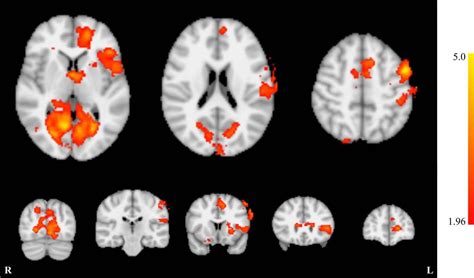Neurofeedback Shows Promise In Treating Tinnitus Neuroscience News