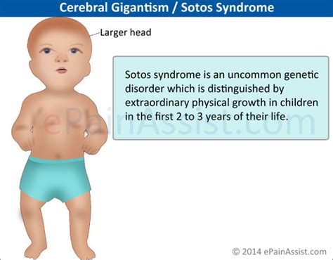 Sotos Syndrome Treatment Prognosis Symptoms Genetic Cause