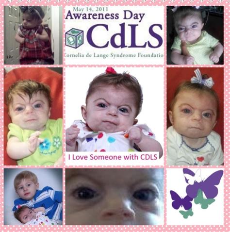 Cdls Awareness Day I Love Someone Rare Disease Cornelia Helping