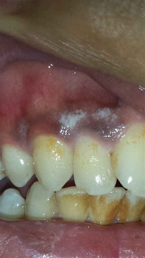 White Bumps On Gums
