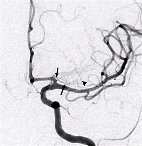 Middle Cerebral Artery Neuroangio Org