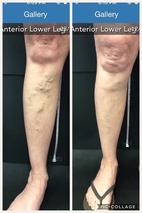 Before And After Vein Treatments Vein Specialists Of The Carolinas