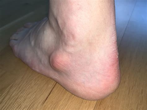 Why Do I Have An Extra Bump Below The Ankle Joint Rpodiatry